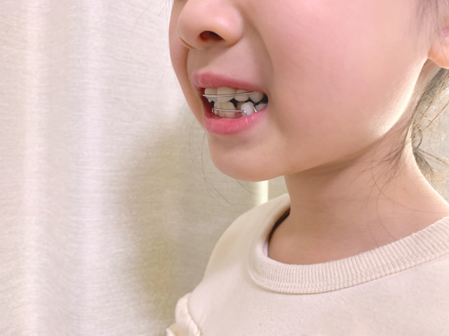 成長期矯正（子どもの第1期矯正）